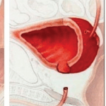 Prostatectomia Radical