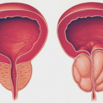 Hiperplasia benigna da próstata: novo método brasileiro de tratamento recebe destaque mundial