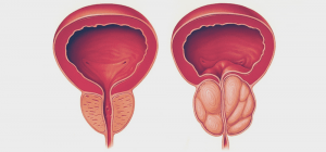 Leia mais sobre o artigo Hiperplasia benigna da próstata: novo método brasileiro de tratamento recebe destaque mundial