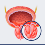 Próstata aumentada: saiba quando a cirurgia é indicada