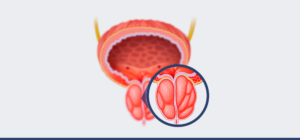 Leia mais sobre o artigo Próstata aumentada: saiba quando a cirurgia é indicada