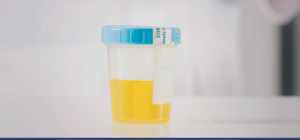 Leia mais sobre o artigo Biomarcadores na urina ajudam a detectar o câncer de próstata