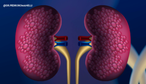 Leia mais sobre o artigo Conheça os fatores de risco de câncer renal e aprenda a prevenir