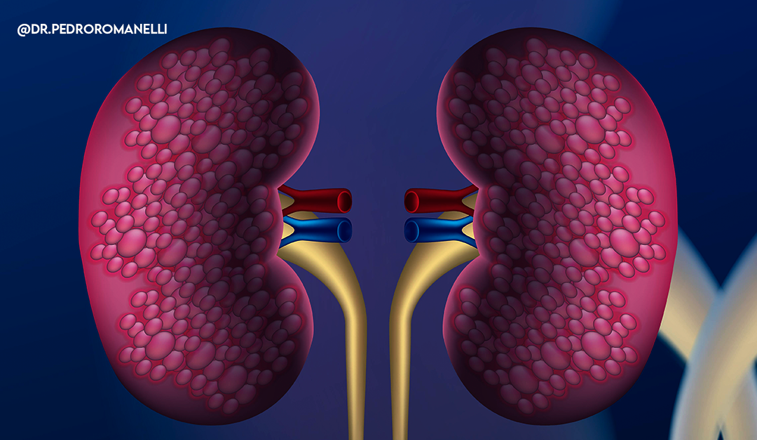 Você está visualizando atualmente Conheça os fatores de risco de câncer renal e aprenda a prevenir